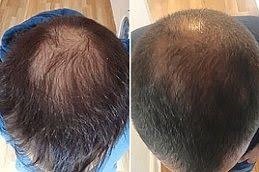 زراعة الشعر بالخلايا الجذعية زراعة الشعر بالخلايا الجذعية في دبي وأبو ظبي والشارقة والعين