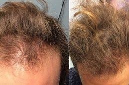 زراعة الشعر بالخلايا الجذعية في دبي وأبو ظبي والشارقة والعين
