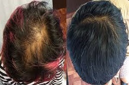 زراعة الشعر بالخلايا الجذعية زراعة الشعر بالخلايا الجذعية في دبي وأبو ظبي والشارقة والعين