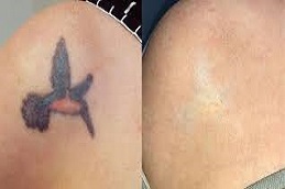 إزالة الوشم في دبي إزالة الوشم في دبي