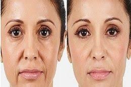 حشوات فولايت في دبي وأبو ظبي والشارقة والعين