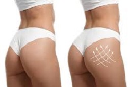 تكبير المؤخرة في دبي وأبو ظبي والشارقة والعين