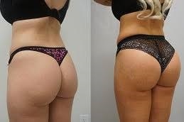 تكبير المؤخرة في دبي وأبو ظبي والشارقة والعين