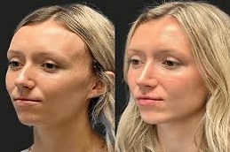 عملية تكبير الذقن في دبي وأبو ظبي والشارقة والعين