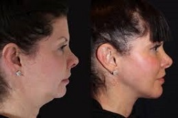 عملية تكبير الذقن في دبي وأبو ظبي والشارقة والعين