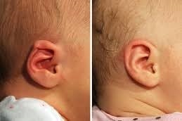 إزالة الزوائد الجلدية أمام الأذن في دبي وأبو ظبي