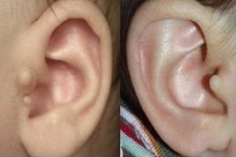 إزالة الزوائد الجلدية أمام الأذن في دبي وأبو ظبي