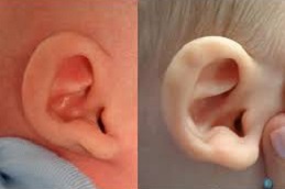 إزالة الزوائد الجلدية أمام الأذن في دبي وأبو ظبي