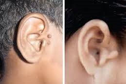 إزالة الزوائد الجلدية أمام الأذن في دبي وأبو ظبي