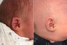 إزالة الزوائد الجلدية أمام الأذن في دبي وأبو ظبي
