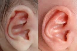 إزالة الزوائد الجلدية أمام الأذن في دبي وأبو ظبي