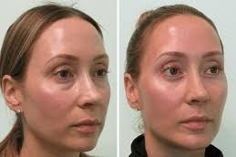 إزالة كيس العين في دبي وأبو ظبي والشارقة والعين