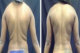 نقل الدهون في دبي وأبو ظبي والشارقة والعين