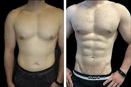 حقن الدهون / نقل الدهون نقل الدهون في دبي وأبو ظبي والشارقة والعين