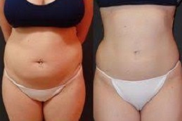 حقن الدهون / نقل الدهون نقل الدهون في دبي وأبو ظبي والشارقة والعين