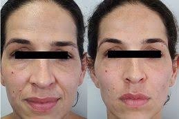 حقن الفيلر في دبي وأبوظبي