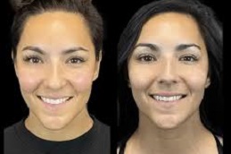 حقن الفيلر في دبي وأبوظبي