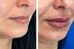 حقن الفيلر في دبي وأبوظبي