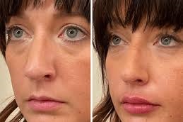 حقن الفيلر في دبي وأبوظبي