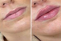 حقن الفيلر في دبي وأبوظبي