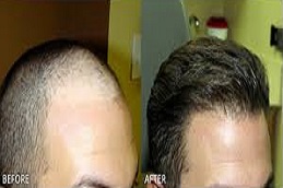 علاج زراعة الشعر بالاقتطاف في دبي وأبو ظبي والشارقة والعين