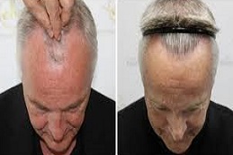 علاج زراعة الشعر بالاقتطاف في دبي وأبو ظبي والشارقة والعين