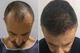 علاج زراعة الشعر بالاقتطاف في دبي وأبو ظبي والشارقة والعين