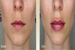 تكبير الشفاه في دبي تكبير الشفاه في دبي وأبو ظبي والشارقة والعين