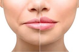 تكبير الشفاه في دبي تكبير الشفاه في دبي وأبو ظبي والشارقة والعين