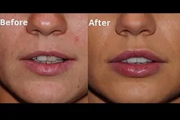 تكبير الشفاه في دبي تكبير الشفاه في دبي وأبو ظبي والشارقة والعين