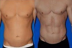 شفط الدهون بالفيزر رباعي الأبعاد في دبي وأبو ظبي والشارقة والعين