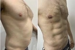 شفط الدهون بالفيزر رباعي الأبعاد في دبي وأبو ظبي والشارقة والعين