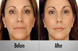 مصاص دماء شد الوجه مصاص دماء شد الوجه في دبي وأبو ظبي والشارقة والعين