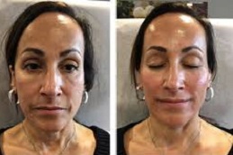 مصاص دماء شد الوجه مصاص دماء شد الوجه في دبي وأبو ظبي والشارقة والعين