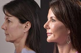 تكلفة جراحة شد الرقبة في دبي، الإمارات العربية المتحدة