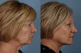 تكلفة جراحة شد الرقبة في دبي، الإمارات العربية المتحدة