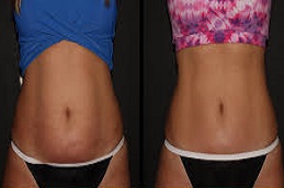 تكلفة نحت الجسم والخصر في دبي