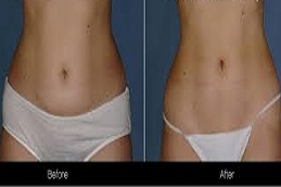 تكلفة نحت الجسم والخصر في دبي