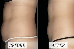 تكلفة نحت الجسم والخصر في دبي