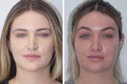 تكلفة جراحة رفع الحاجب في دبي