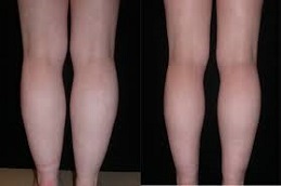 تكلفة عملية تصغير الساق في دبي تكلفة جراحة تصغير ربلة الساق في دبي