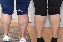 تكلفة جراحة تصغير ربلة الساق في دبي