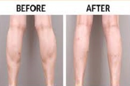 تكلفة جراحة تصغير ربلة الساق في دبي