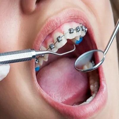 الدليل الشامل لتقويم الأسنان في دبي الدليل الشامل لتقويم الأسنان في دبي