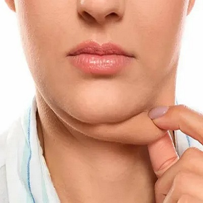 تكلفة شفط دهون الذقن المزدوجة في دبي