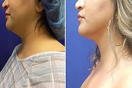 Double chin liposuctionn2