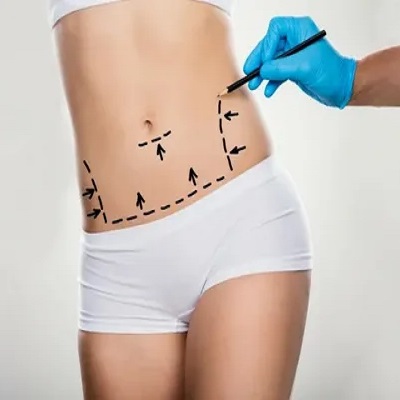 عملية شفط الدهون بتقنية HD في دبي وأبوظبي والشارقة والعين