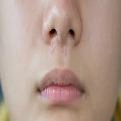 الدليل الشامل لعلاج الندبات الضخامية الدليل الشامل لعلاج الندبات الضخامية