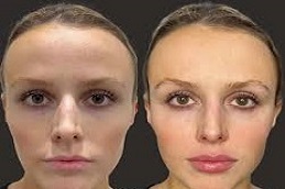 تكلفة تكبير الشفاه في دبي