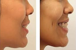 تكلفة تشكيل الغمازة في دبي تكلفة جراحة ديمبل خلق في دبي وأبو ظبي والشارقة والعين